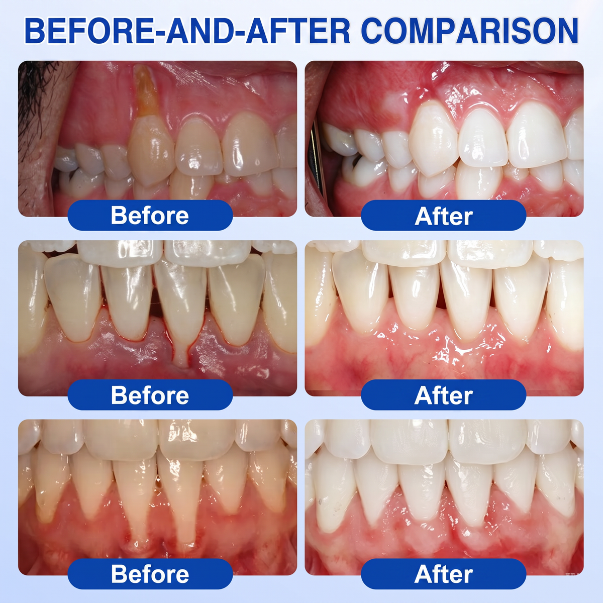 GumRevive periodontal repair gel